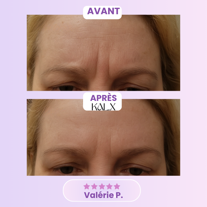 KAL.X™ Bandes Lifting Collagène